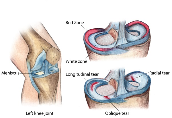 A graphic showing the anatomy of the human knee and the types of meniscus tears