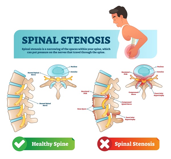 Spinal stenosis vs. a healthy spine.