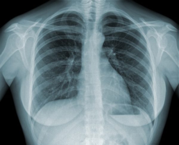 Pulmonary Embolism