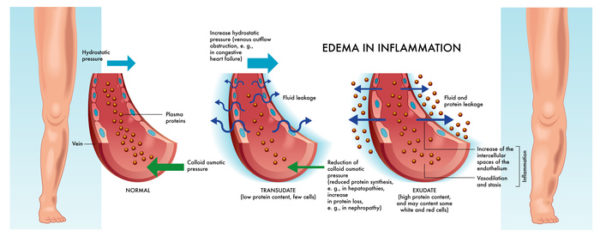 Arm/Leg Injuries, Edema, and Swelling After a Crash | Gary Martin Hays ...