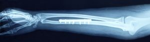 Bone fracture x-ray